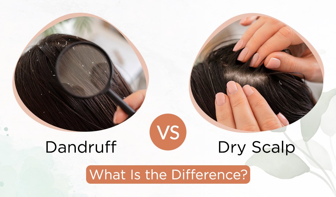 Dandruff Vs Dry Scalp