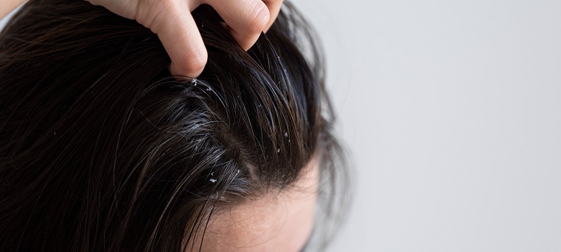 Symptoms-of-Dandruff-and-Dry-Scalp