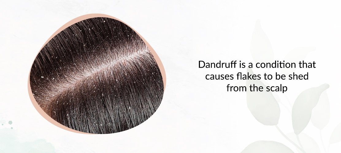 What-is-Dandruff